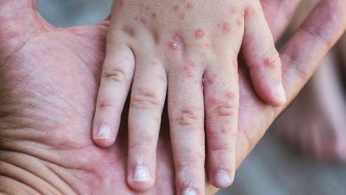 Photo of الولايات المتحدة تسجل أكثر من 800 حالة إصابة بالحصبة منذ بداية العام